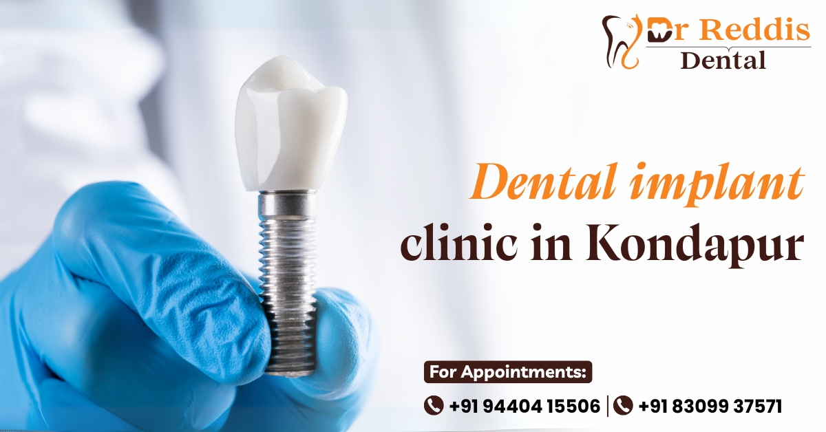 Dental Implant Clinic in Kondapur – Dr Reddis Dental Clinic