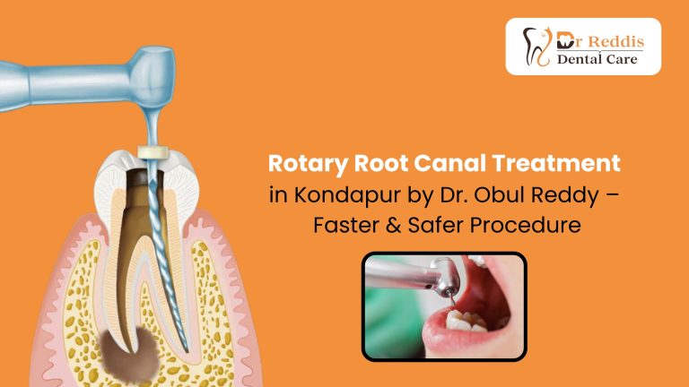 Rotary Root Canal Treatment in Kondapur by Dr. Obul Reddy – Faster & Safer Procedure