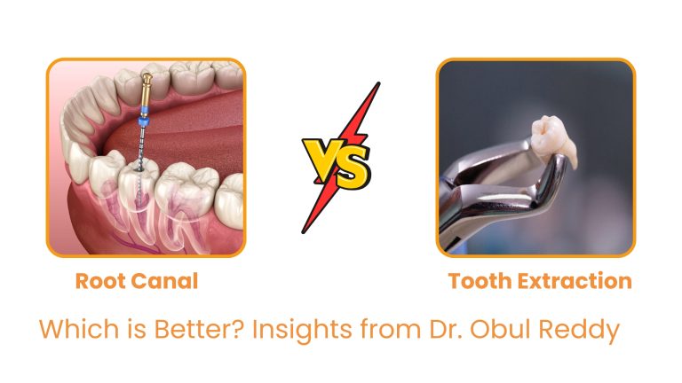 Root Canal vs Tooth Extraction: Which is Better? Insights from Dr. Obul Reddy | Dr. Reddis Dental Clinic