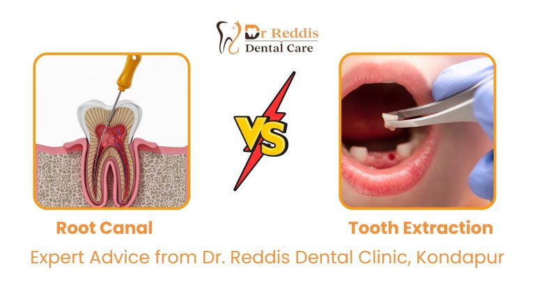 Root Canal vs Tooth Extraction: Expert Advice from Dr. Reddi’s Dental Clinic, Kondapur