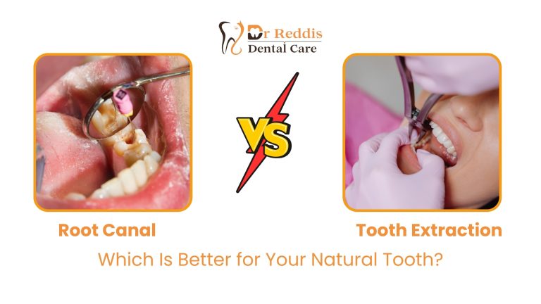 Root Canal vs Tooth Extraction: Which Is Better for Your Natural Tooth?
